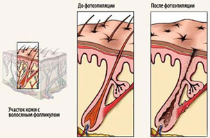 Эпиляция и депиляция: способы и методы удаления волос